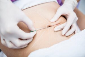 chirurgie esthetique