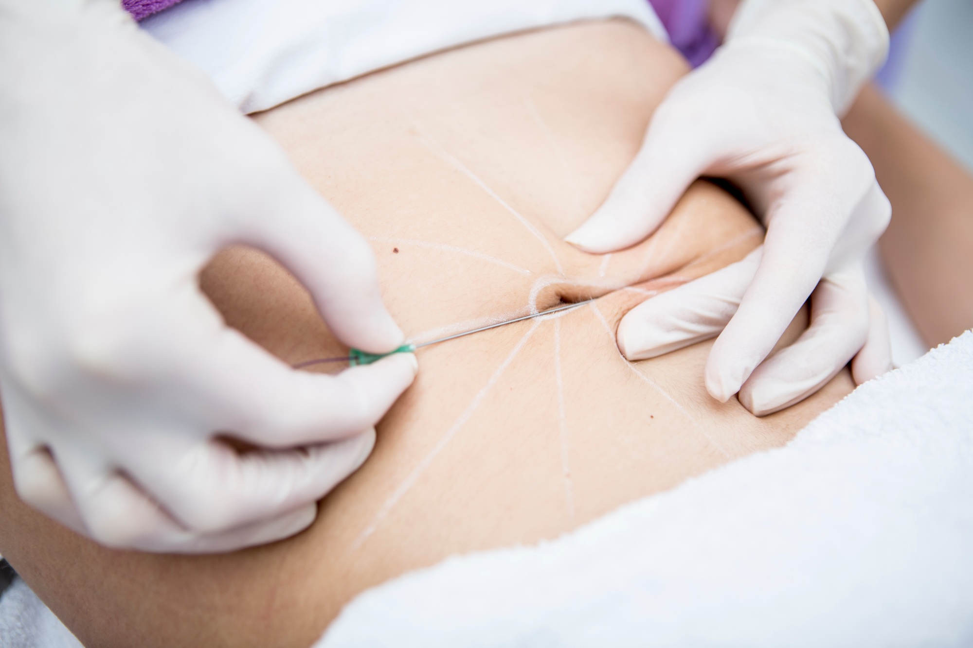 chirurgie esthetique